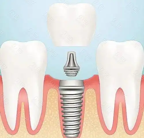 种植牙示意图