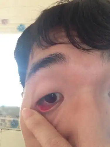 昨天早上起床就感觉眼睛(下眼皮)有点疼痛,当时没太注意.