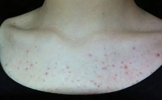 胸前长这种疙瘩要赶紧去医院或是大病前兆