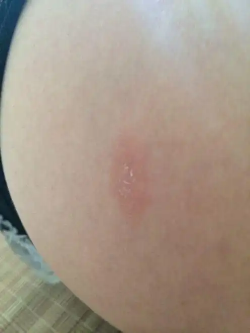 体癣有什么特点呢_体癣症状_大成皮肤网