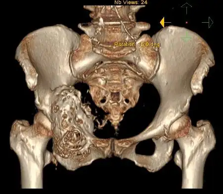 头条团队的力量市一院成功开展高难度半骨盆置换术