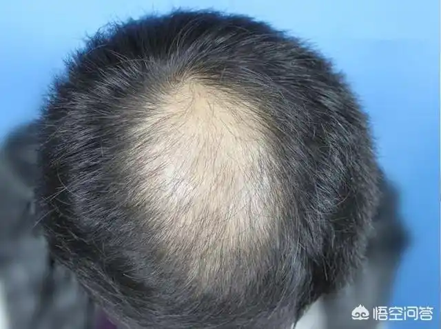 头条问答 - 男生脱发成地中海,怎么选择发型?(4个回答)