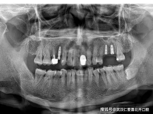 【种牙案例】种一口好牙 开启不一样的精彩_手机搜狐网