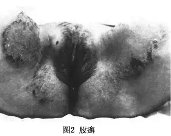 临床表现:股癣初发时为股部内侧靠近阴囊处出现潮红,小丘疹,继而在
