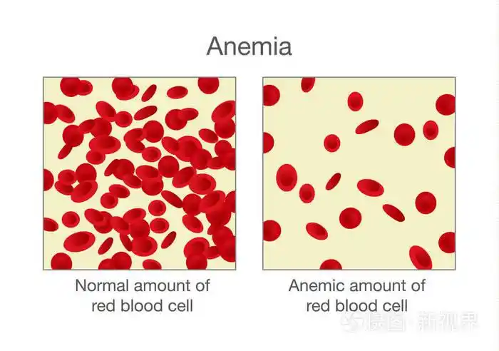 正常的大量红细胞和贫血的区别