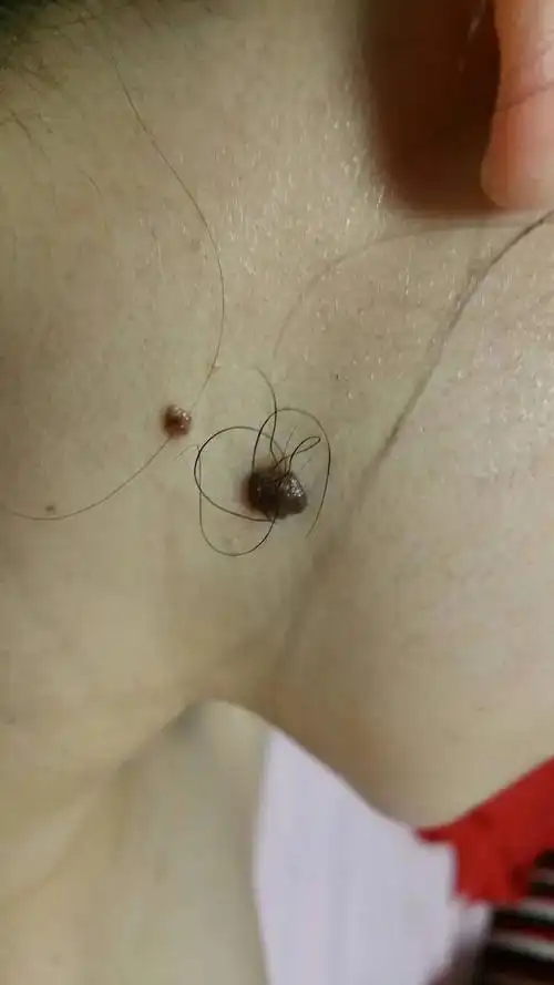 面相痣突然长毛 痣相长毛好不好
