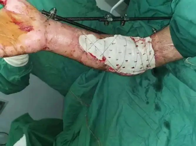 遵义男子遭遇断臂伤医生做完手术二十天后竟发现