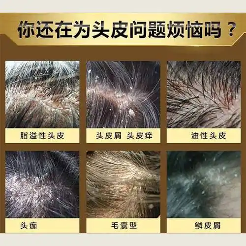 用什么洗发水能去头皮痒止痒去屑的洗发膏推荐