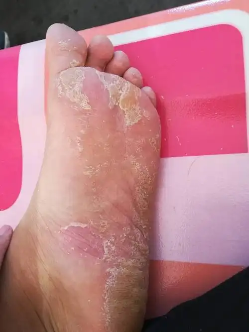 我这脚怎么了 大二开始一只脚起皮 大三变成二只脚了