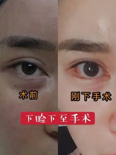 下睑下至术后当天