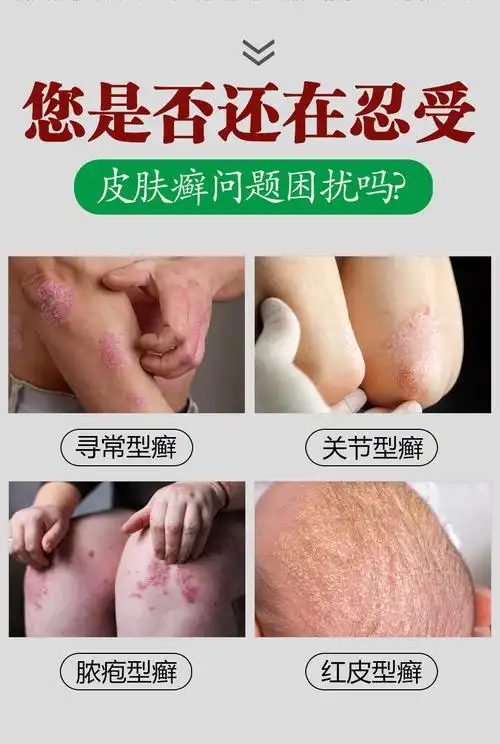 御医堂皮必康湿s疹牛皮瘙痒银x屑廯外用乳膏一盒装