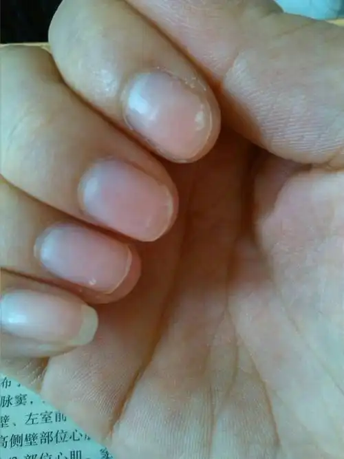 问:指甲上的白色点是什么?是不是身体不健康的表现呢?