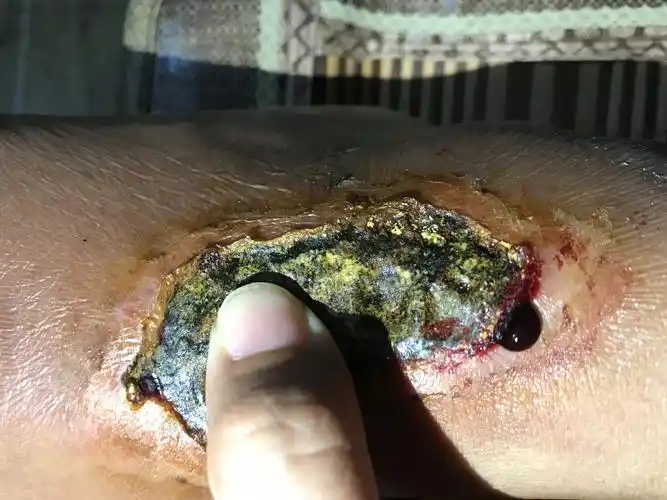 擦伤已经结痂,但是还会从边上渗出黑色的淤血该怎么办