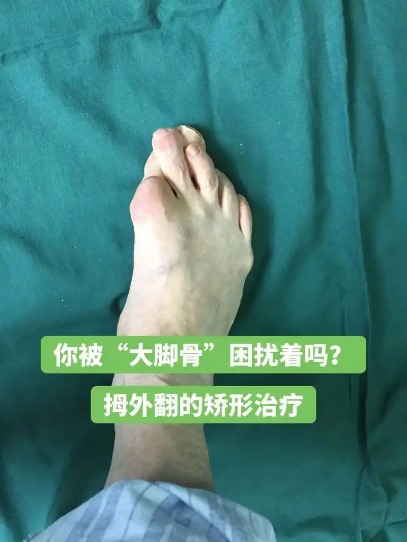 你还被"大脚骨"困扰着呢吗?来看看拇外翻.#图文扶持计划入口 - 抖音