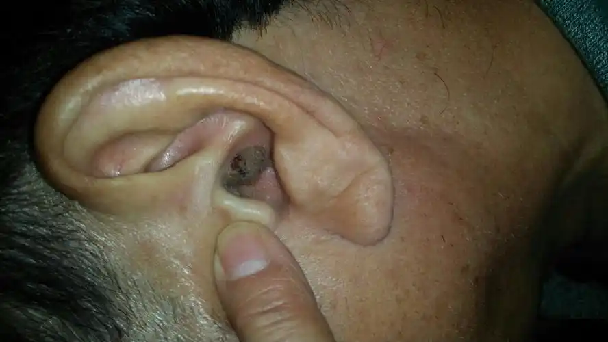 我爸耳朵里不知道什么时候长了一个黑色的疙瘩,不疼不痒,问他什么时候