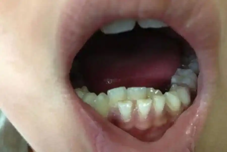 孩子嘴里竟然长出两排牙,到医院检查后,宝妈肠子已悔青!