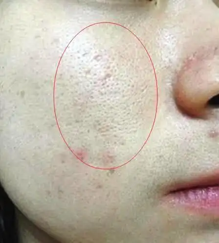 觉得自己的毛孔大看上去皮肤粗糙不细腻导致上妆不服贴