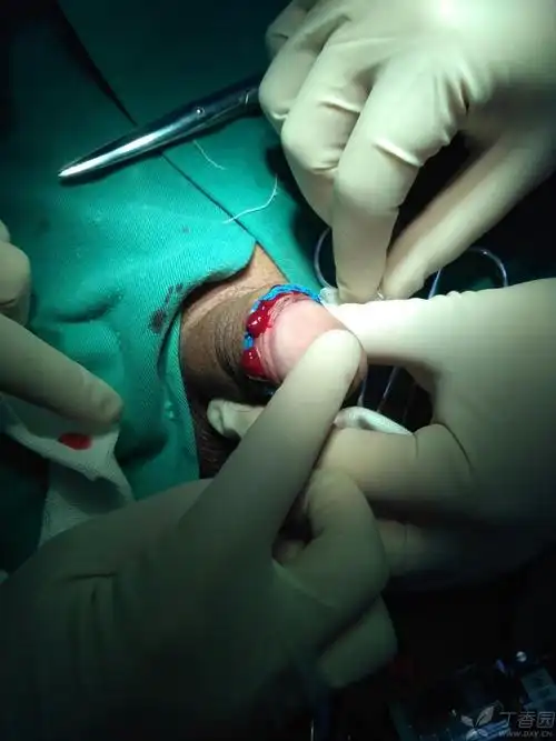 包皮环切吻合器有问题