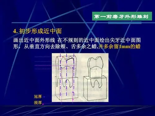 上颌第一前磨牙外形雕刻ppt