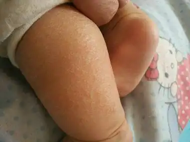 维生素a缺乏症患者的皮肤损害表现为腿部皮肤干燥粗糙,没有光泽,广泛