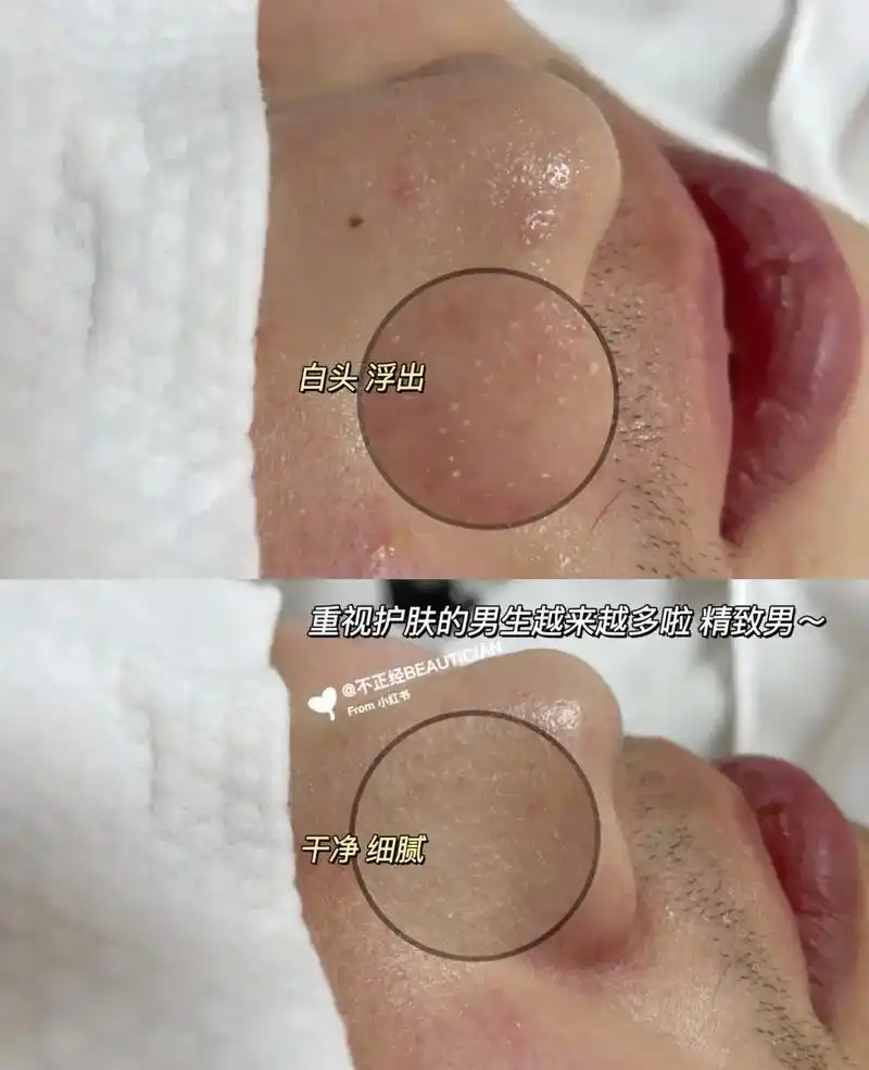 黑头粉刺看过来