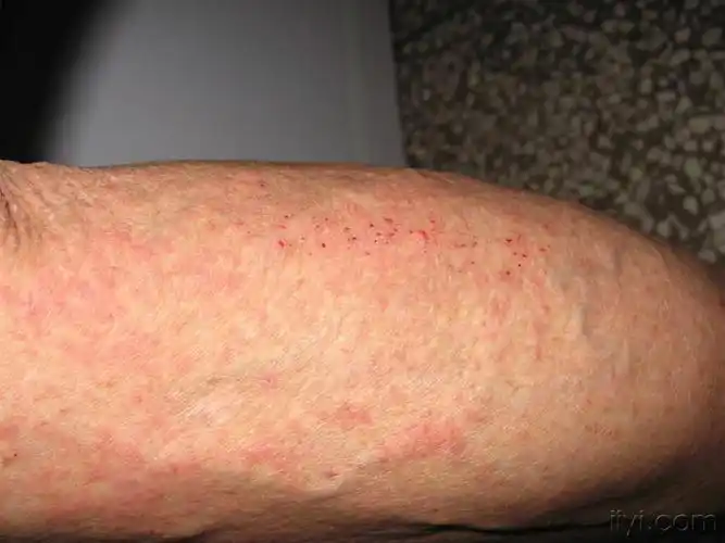 看图说话---老年瘙痒症继发湿疹样变?