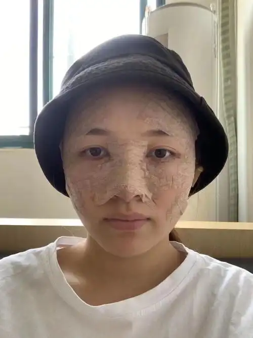 自体脂肪填充全脸第三天;刚做完那会肿胀是真的严重,现在已经好了很多