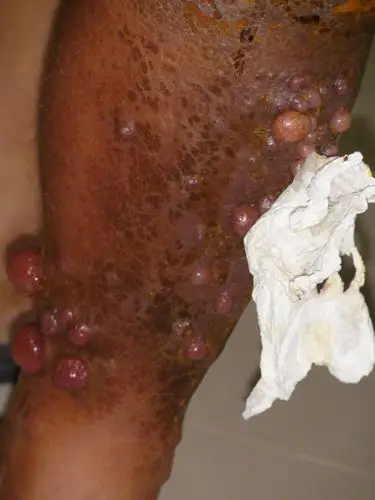 横纹肌肉瘤(leimyosarcoma)
