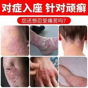 癣药膏外用皮肤堂