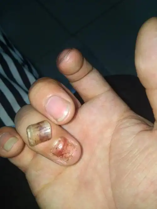 我指甲这样还会有指甲长出了吗?好恐怖啊