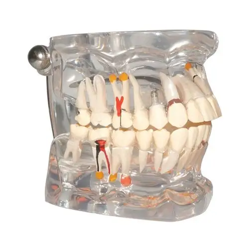 透明蛀牙模型 牙齿生长模型 可拆牙齿模型