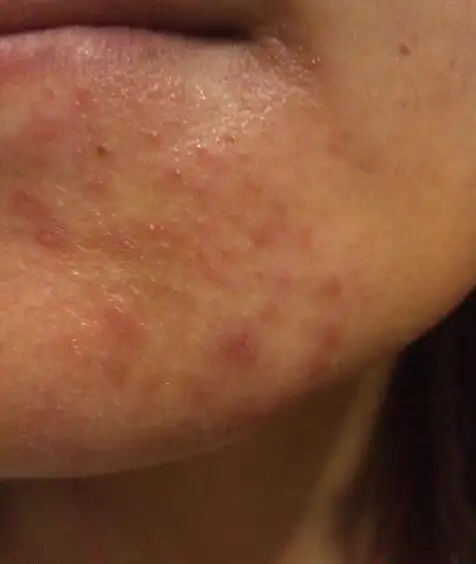 不能喝水或者下雨天不能被雨淋,因为她的皮肤与水接触后会起大片红疹