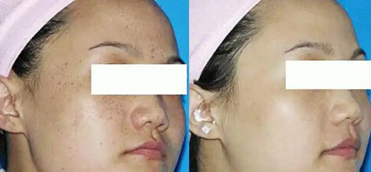 改善皮肤粗糙对比图