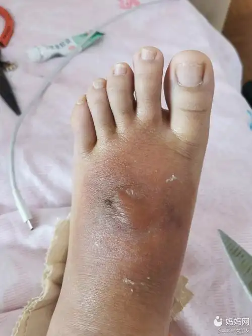 烫伤第七天,今天水泡增大了很多,从晚上开始脚背边缘_妈妈网轻聊_千万