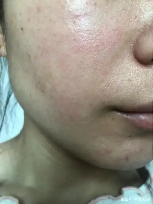 面部皮肤屏障受损,这几点一定要注意