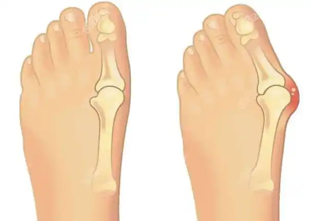 北京正规大脚骨医院圣嘉新看的如何?