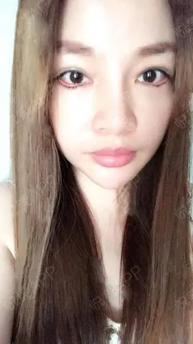 眼综合术后1天_开眼角术后1天_双眼皮术后1天_眼部整形术后1天_sey