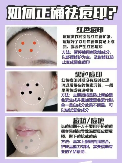 先确定痘印类型不做医美也能轻松去除
