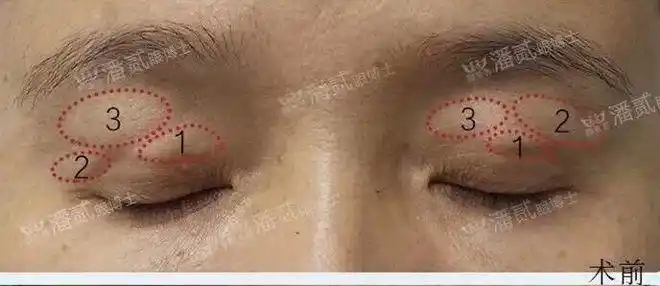 3个脂肪填充后不幸结块的姑娘,脂肪填充眼窝真的不靠谱吗?