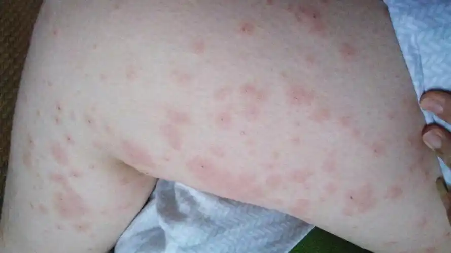 孕晚期长疹子医生说是湿疹,我感觉不太像