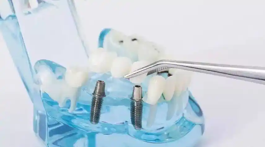 口腔科普千万别因为这些误区而耽误种植牙最好时机