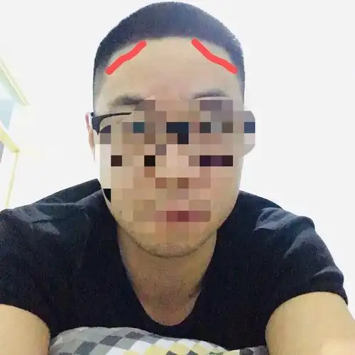 两侧发际线太低