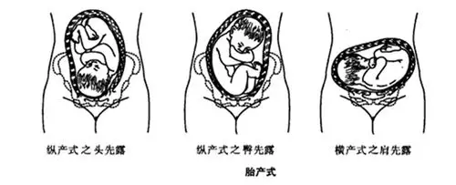 胎位异常