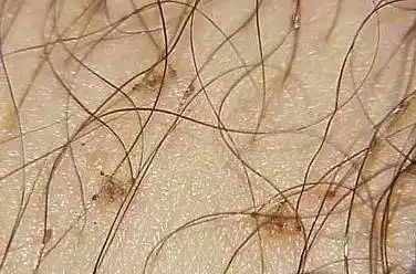 女人阴虱的症状图片