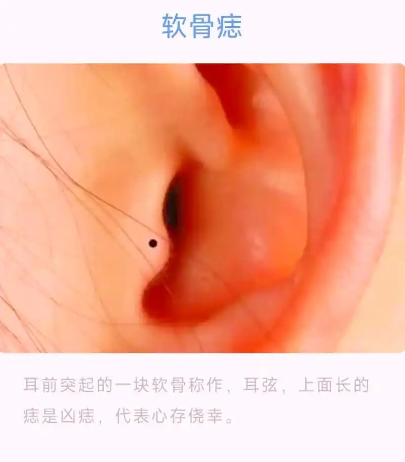 揭秘有痣青年的易学密码之耳.