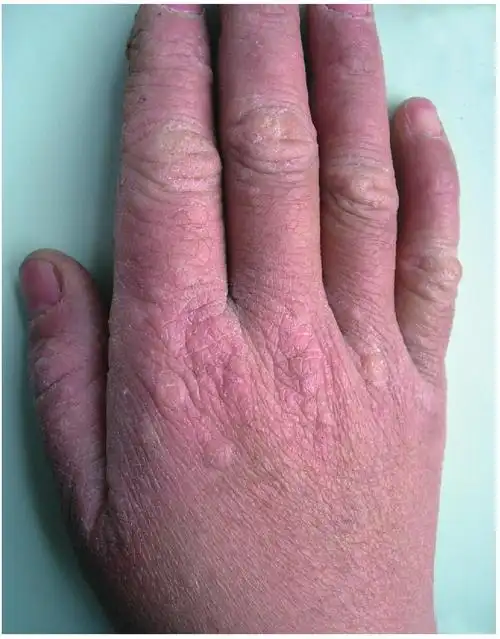 第九节 砷角化病-临床皮肤性病-医学