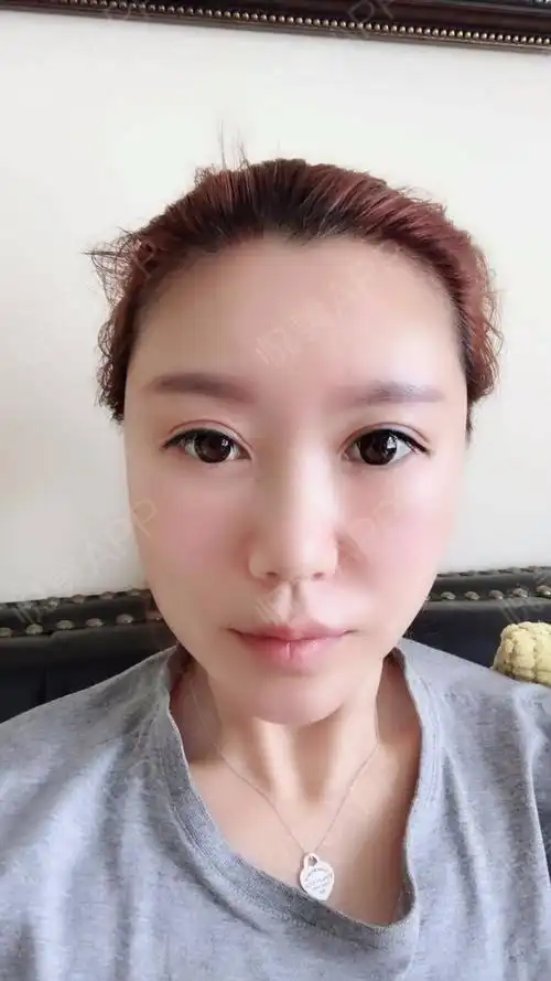 自体脂肪面部填充术后3天_面部填充术后3天_自体脂肪术后3天_面部轮廓