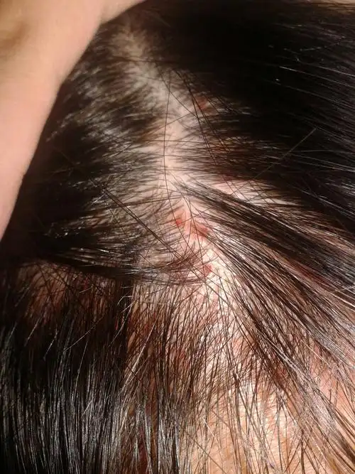 头上长很多包 会破掉 一直不会好是怎么回事呢⊙﹏