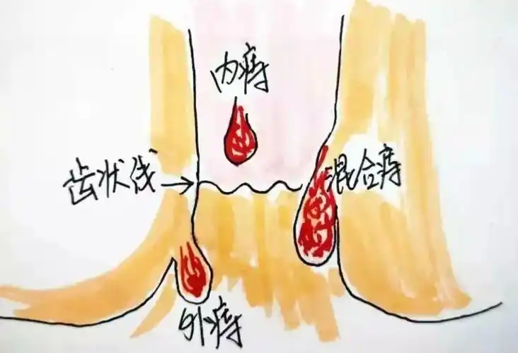 痔疮的症状是什么样的?