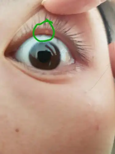 慎入 眼睑的地方长了黄色的水泡?有姐妹知道怎么办.